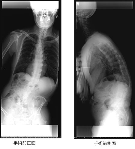 成人脊柱変形症