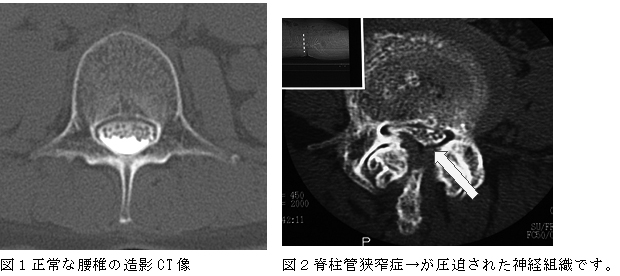 頚椎症性脊髄症 整形外科