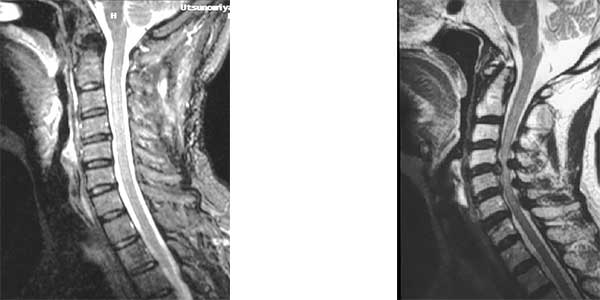 頚椎症性脊髄症 整形外科