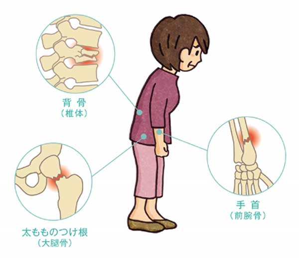 骨粗鬆症