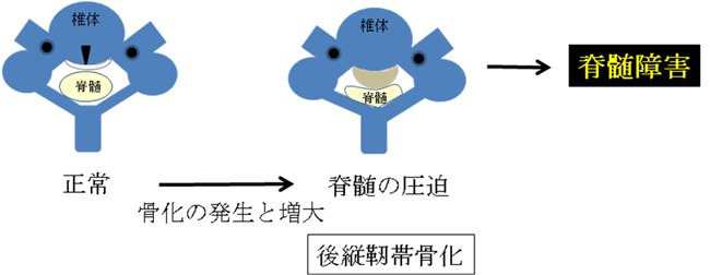 頚椎後縦靭帯骨化症