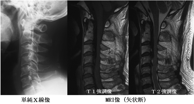 頚椎後縦靭帯骨化症