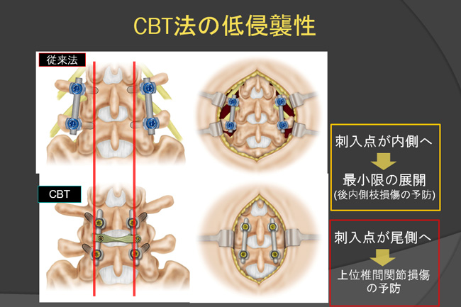 Cortical bone trajectory