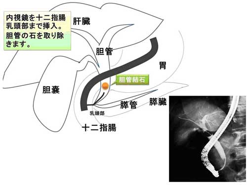 胆管結石