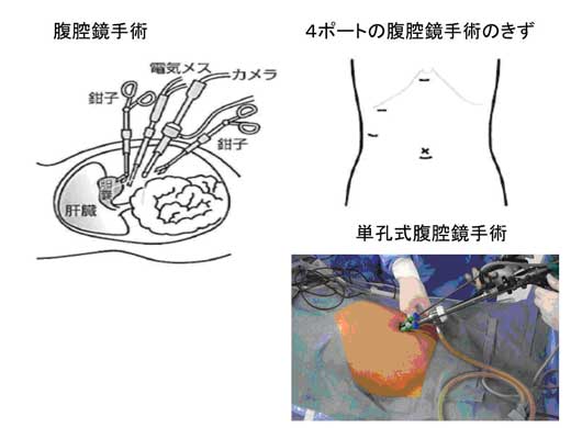 胆石症