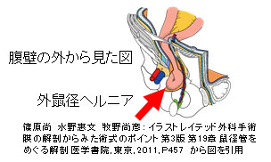 お腹のヘルニア