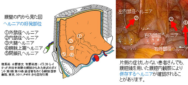 ヘルニア